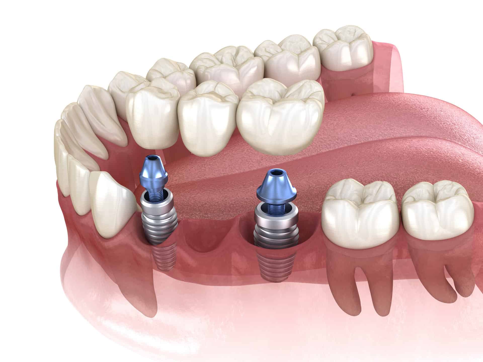 Coronas dentales sobre diente e implante