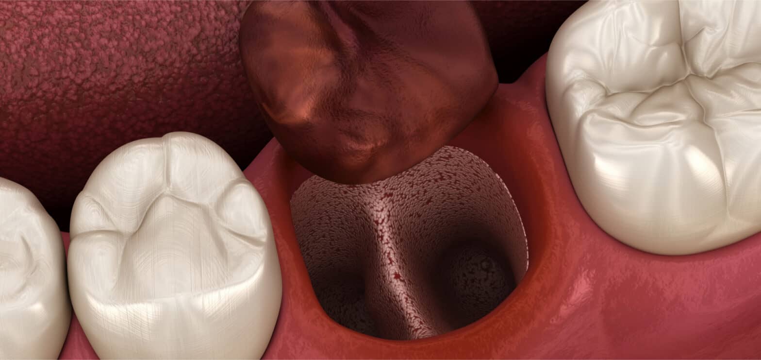 Alveolitis Sicca Nach 7 Tagen Alveolitis: causas, tipos y tratamientos - Udemax