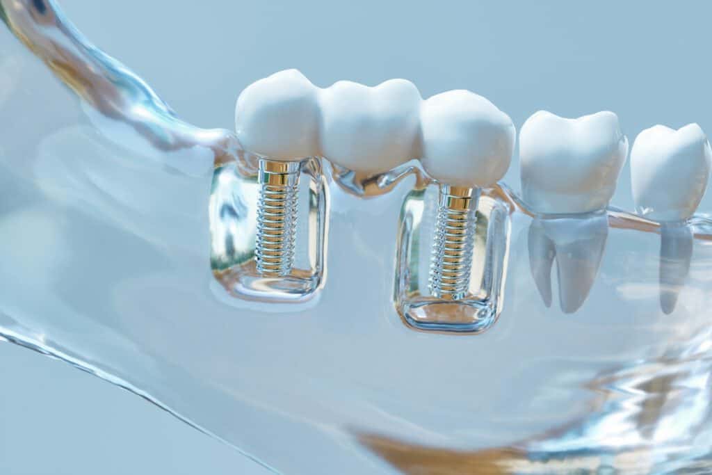 Limpieza de implantes dentales