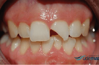 Caso clínico de reconstrucción dental - antes