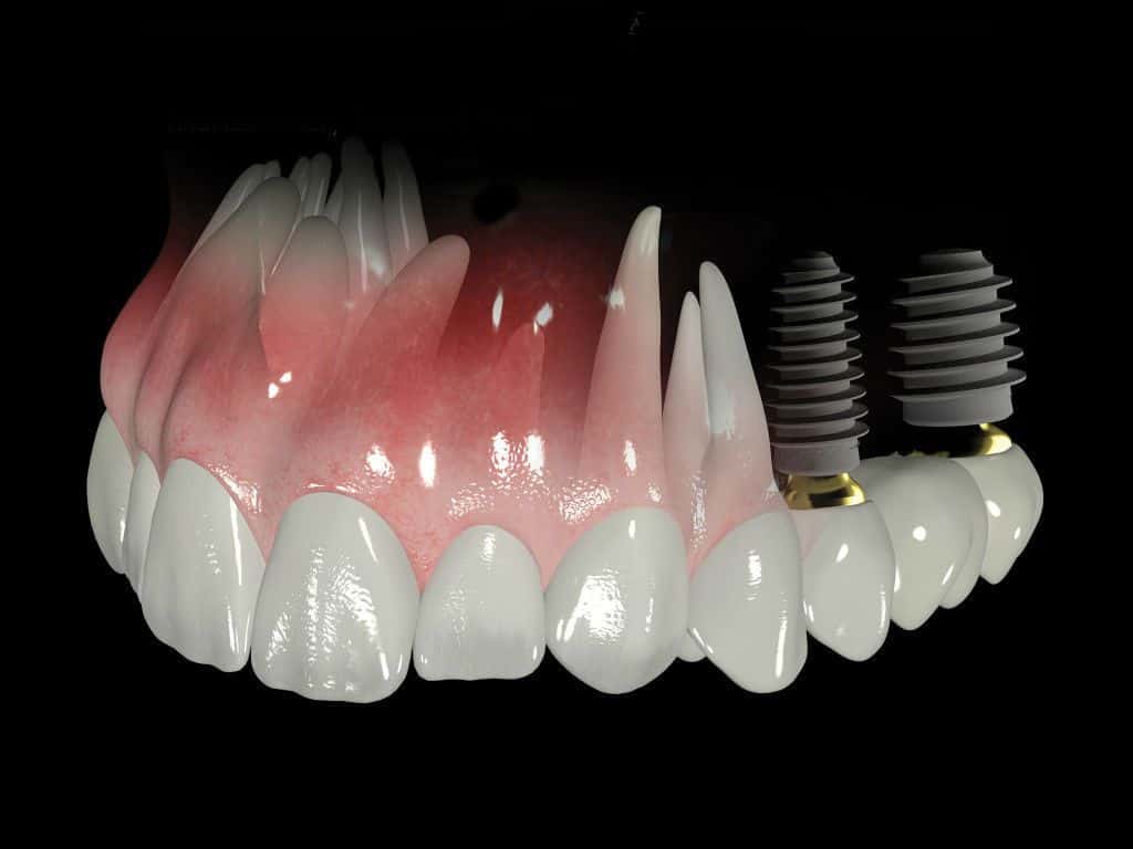 implantes-dentales-udemax