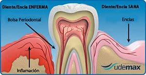 periodoncia udemax